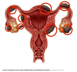Treatment for Fibroids at One Ashford Hospitla in Kent