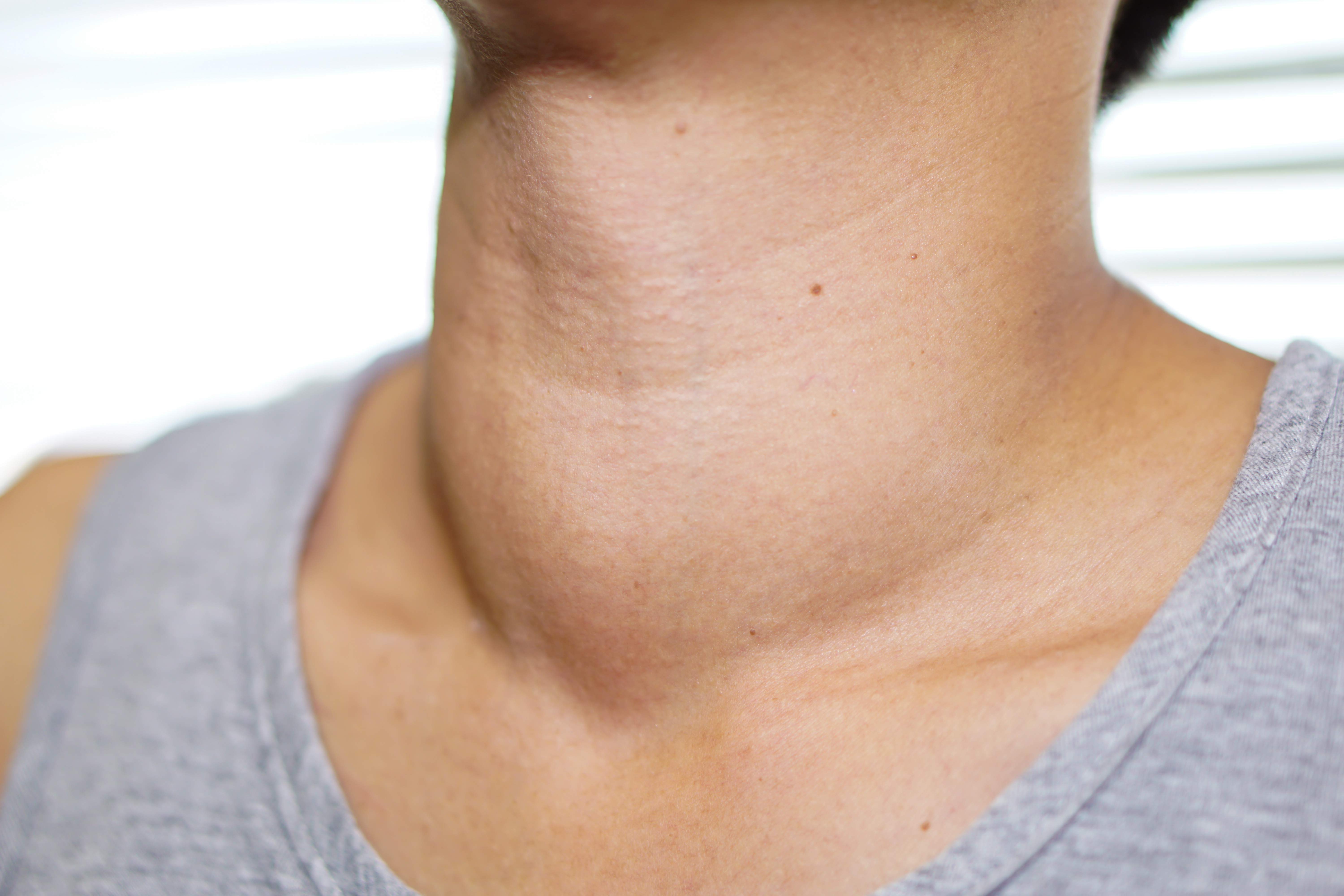 Проблемы с щитовидной симптомы у мужчин. Эндемический зоб щитовидной железы.