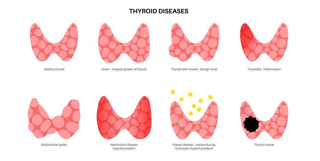 Thyroid disorders and recommended treatment